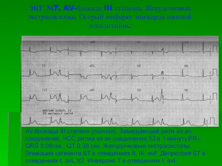 ЭКГ №7. AV-блокада III степени. Желудочковые экстрасистолы. Острый инфаркт миокарда нижней локализации.