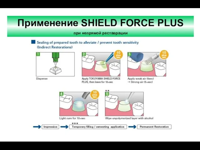 Применение SHIELD FORCE PLUS при непрямой реставрации