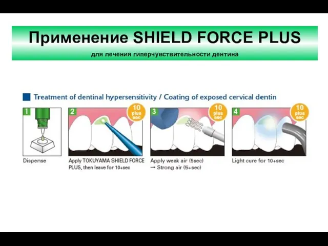 Применение SHIELD FORCE PLUS для лечения гиперчувствительности дентина