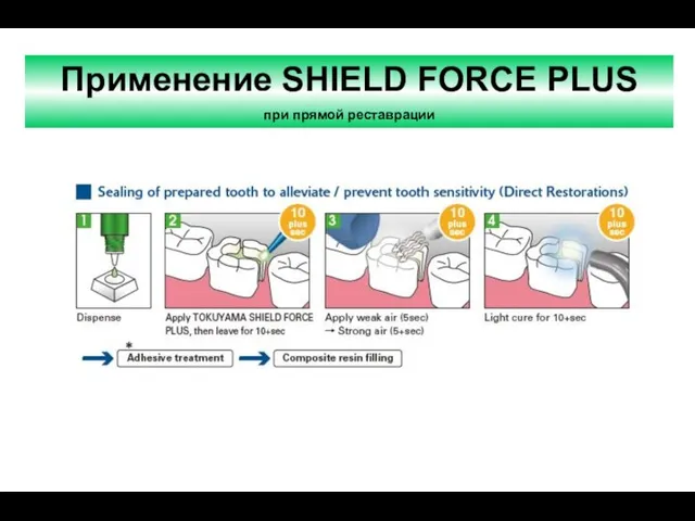 Применение SHIELD FORCE PLUS при прямой реставрации