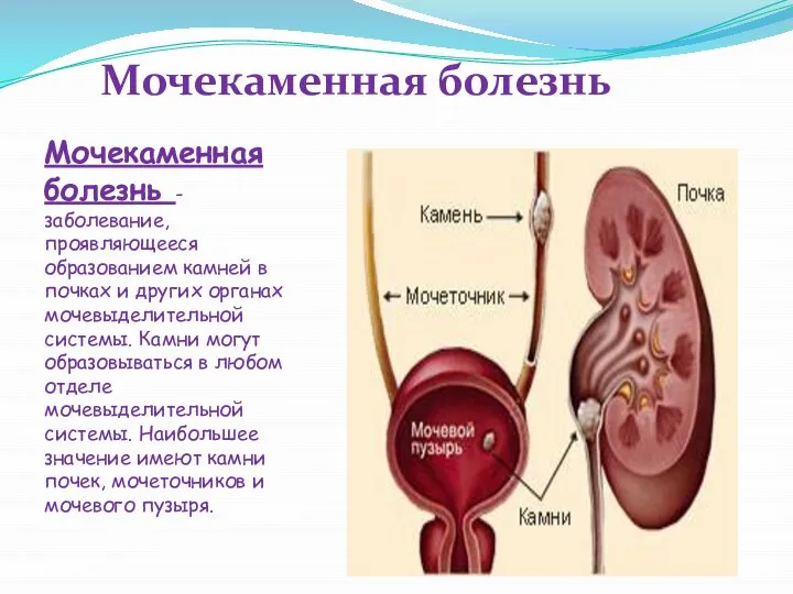 Мочекаменная болезнь Мочекаменная болезнь - заболевание, проявляющееся образованием камней в почках и