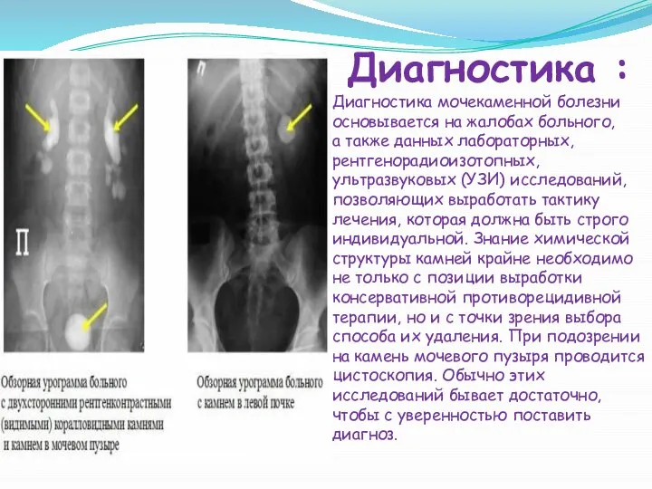 Диагностика : Диагностика мочекаменной болезни основывается на жалобах больного, а также данных