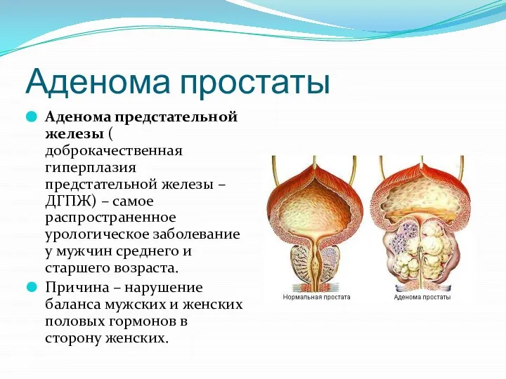 Аденома простаты Аденома предстательной железы ( доброкачественная гиперплазия предстательной железы – ДГПЖ)