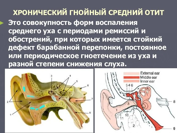 ХРОНИЧЕСКИЙ ГНОЙНЫЙ СРЕДНИЙ ОТИТ Это совокупность форм воспаления среднего уха с периодами