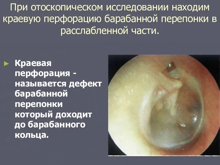 При отоскопическом исследовании находим краевую перфорацию барабанной перепонки в расслабленной части. Краевая