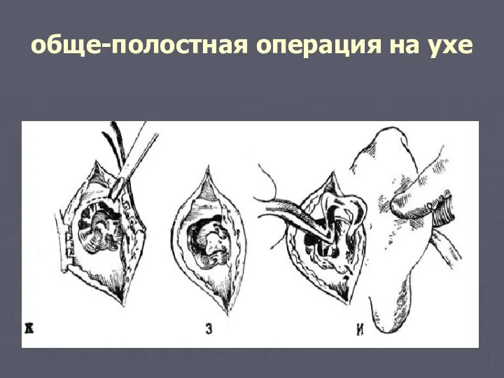 обще-полостная операция на ухе