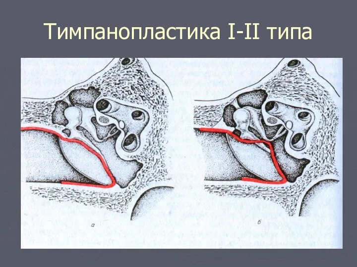 Тимпанопластика І-ІІ типа