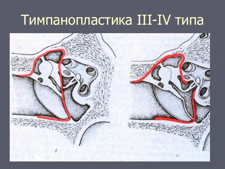 Тимпанопластика ІІІ-ІV типа