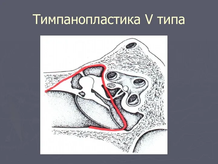 Тимпанопластика V типа