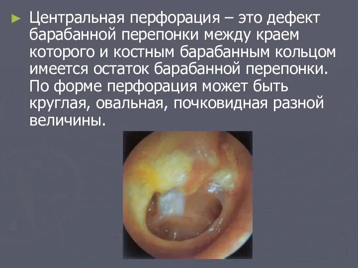 Центральная перфорация – это дефект барабанной перепонки между краем которого и костным