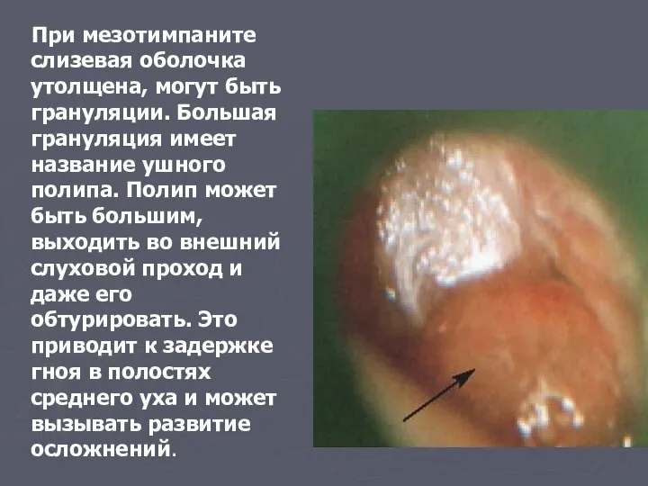 При мезотимпаните слизевая оболочка утолщена, могут быть грануляции. Большая грануляция имеет название
