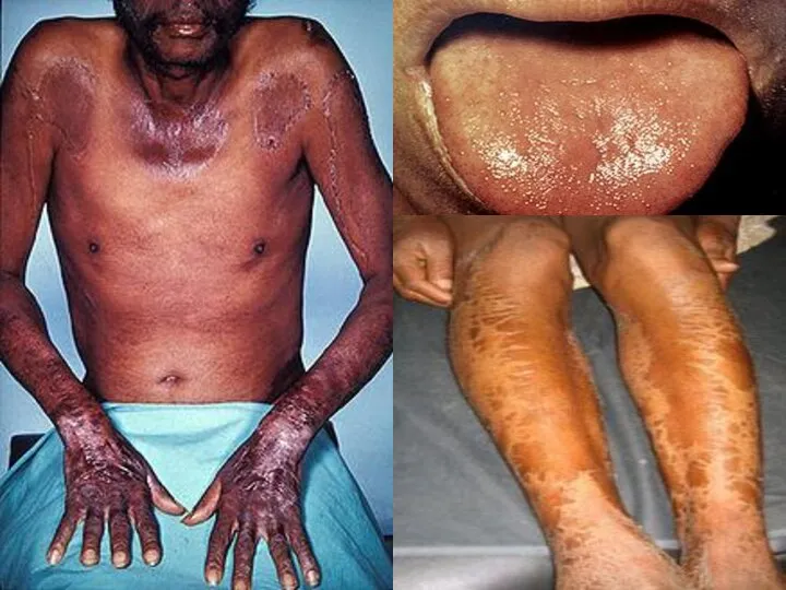 пеллагры — «болезнь трёх Д» — диарея, дерматит, деменция.