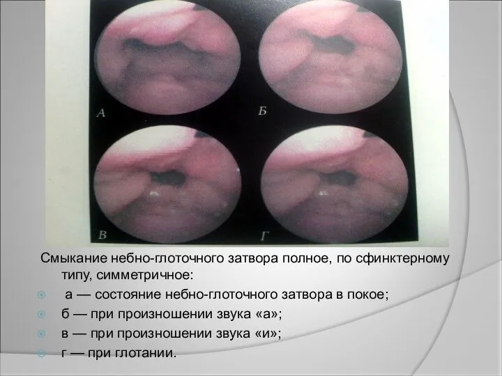 Смыкание небно-глоточного затвора полное, по сфинктерному типу, симметричное: а — состояние небно-глоточного