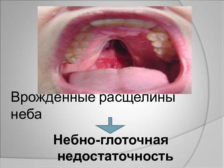 Врожденные расщелины неба Небно-глоточная недостаточность