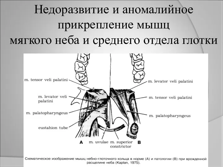 Недоразвитие и аномалийное прикрепление мышц мягкого неба и среднего отдела глотки