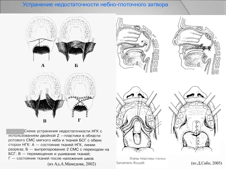 Устранение недостаточности небно-глоточного затвора