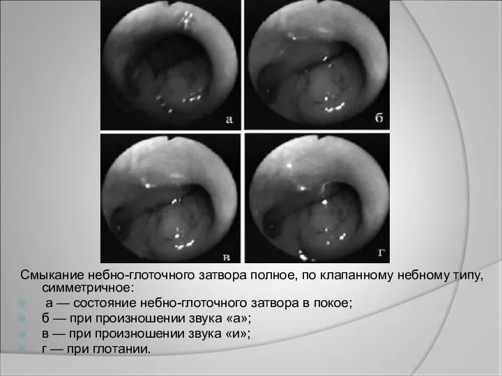 Смыкание небно-глоточного затвора полное, по клапанному небному типу, симметричное: а — состояние