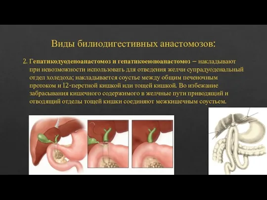 Виды билиодигестивных анастомозов: 2. Гепатикодуоденоанастомоз и гепатикоеюноанастомоз – накладывают при невозможности использовать