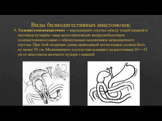 Виды билиодигестивных анастомозов: 4. Холецистоеюноанастомоз – накладывают соустье между тощей кишкой и