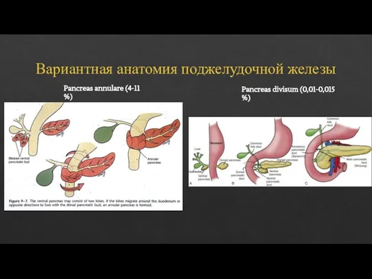 Вариантная анатомия поджелудочной железы Pancreas annulare (4-11 %) Pancreas divisum (0,01-0,015 %)