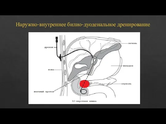 Наружно-внутреннее билио-дуоденальное дренирование