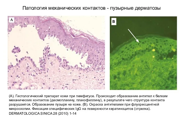 . Патология механических контактов - пузырные дерматозы (А). Гистологический препарат кожи при