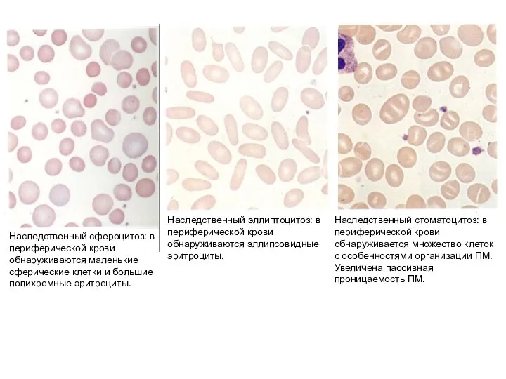Наследственный сфероцитоз: в периферической крови обнаруживаются маленькие сферические клетки и большие полихромные