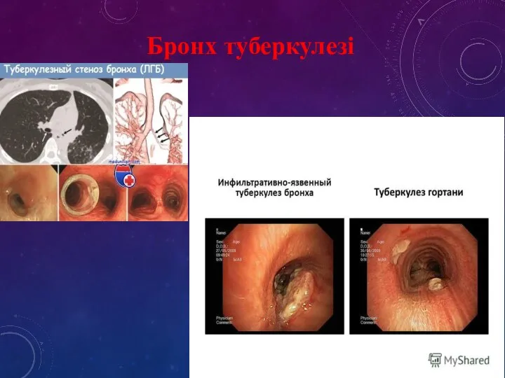 Бронх туберкулезі