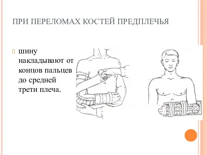 ПРИ ПЕРЕЛОМАХ КОСТЕЙ ПРЕДПЛЕЧЬЯ шину накладывают от концов пальцев до средней трети плеча.