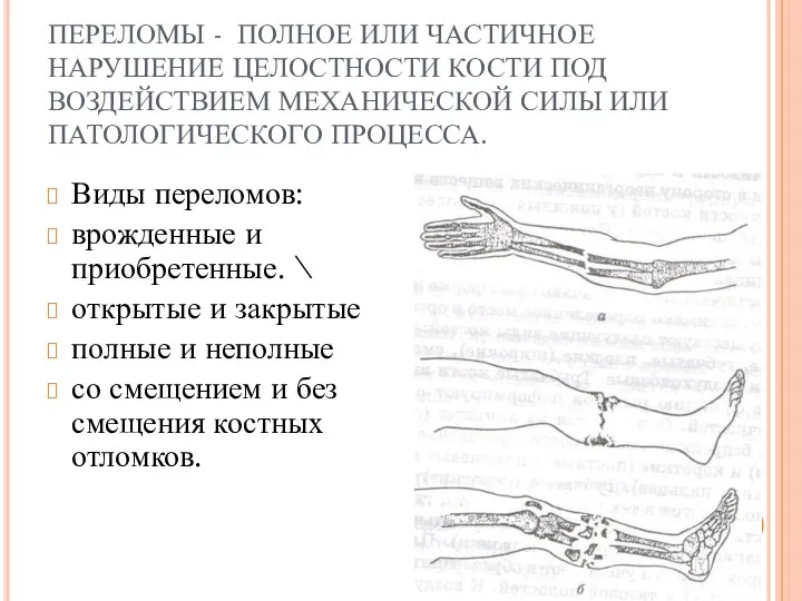 ПЕРЕЛОМЫ - ПОЛНОЕ ИЛИ ЧАСТИЧНОЕ НАРУШЕНИЕ ЦЕЛОСТНОСТИ КОСТИ ПОД ВОЗДЕЙСТВИЕМ МЕХАНИЧЕСКОЙ СИЛЫ