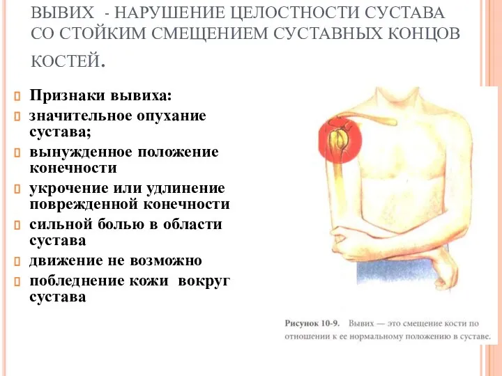 ВЫВИХ - НАРУШЕНИЕ ЦЕЛОСТНОСТИ СУСТАВА СО СТОЙКИМ СМЕЩЕНИЕМ СУСТАВНЫХ КОНЦОВ КОСТЕЙ. Признаки