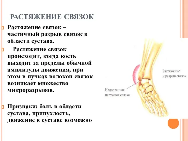 РАСТЯЖЕНИЕ СВЯЗОК Растяжение связок – частичный разрыв связок в области сустава. Растяжение