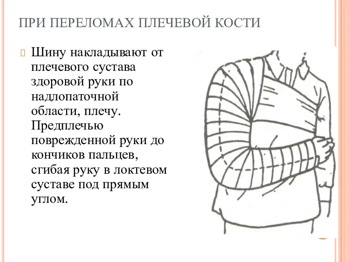 ПРИ ПЕРЕЛОМАХ ПЛЕЧЕВОЙ КОСТИ Шину накладывают от плечевого сустава здоровой руки по