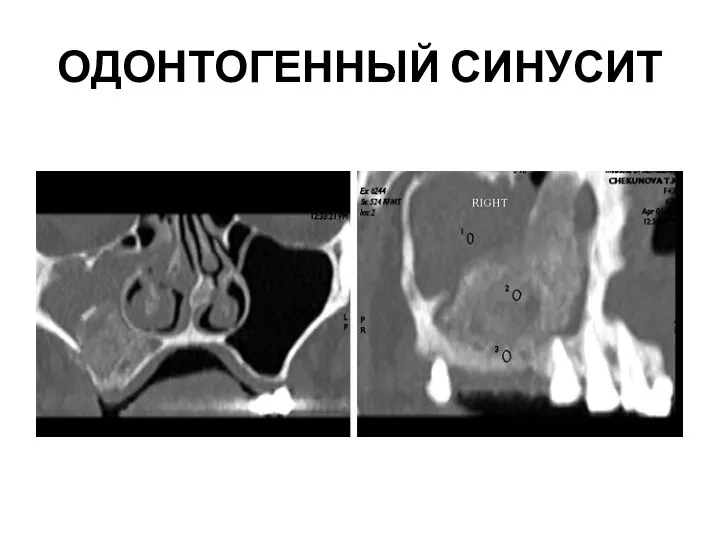 ОДОНТОГЕННЫЙ СИНУСИТ