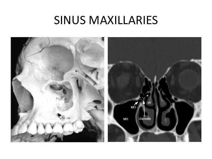 SINUS MAXILLARIES