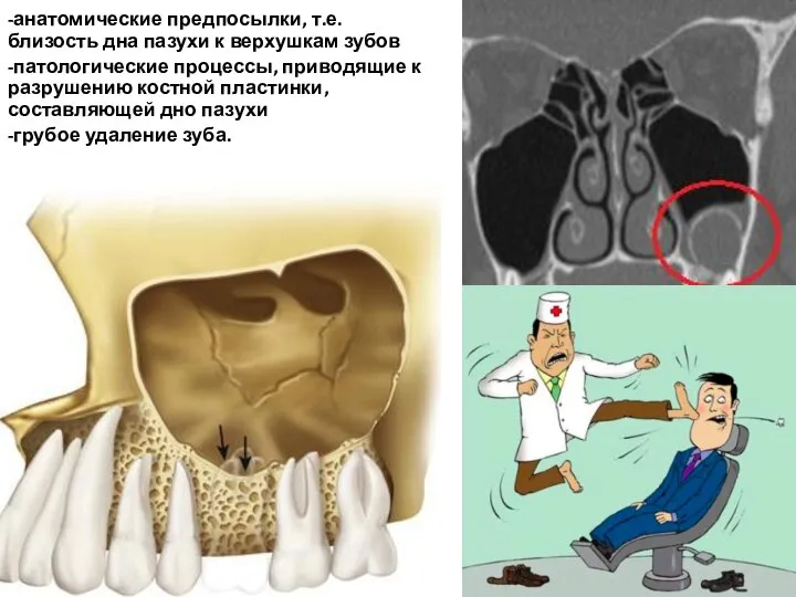 -анатомические предпосылки, т.е. близость дна пазухи к верхушкам зубов -патологические процессы, приводящие