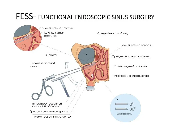 FESS- FUNCTIONAL ENDOSCOPIC SINUS SURGERY
