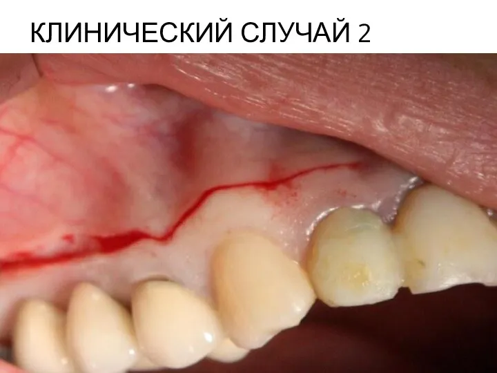 КЛИНИЧЕСКИЙ СЛУЧАЙ 2