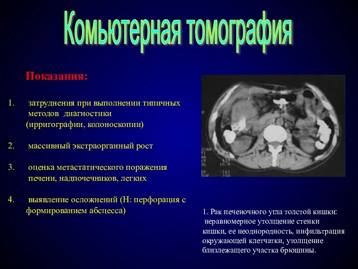 Комьютерная томография Показания: затруднения при выполнении типичных методов диагностики (ирригографии, колоноскопии) массивный