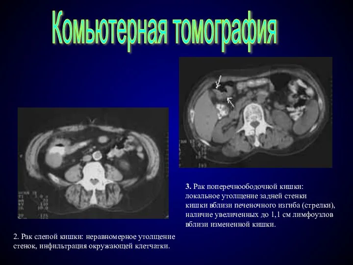 Комьютерная томография 2. Рак слепой кишки: неравномерное утолщение стенок, инфильтрация окружающей клетчатки.