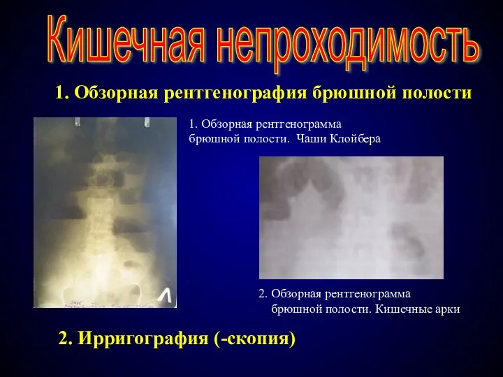 Кишечная непроходимость 1. Обзорная рентгенография брюшной полости 1. Обзорная рентгенограмма брюшной полости.
