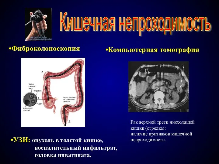 Кишечная непроходимость Фиброколоноскопия УЗИ: опухоль в толстой кишке, воспалительный инфильтрат, головка инвагината.