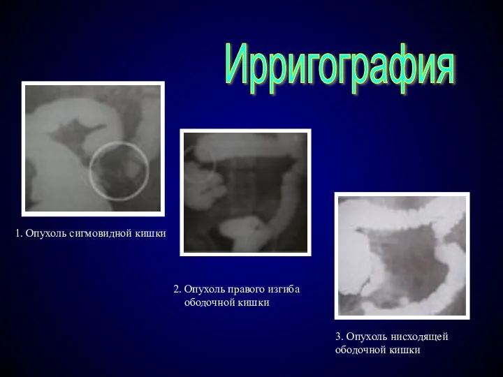 Ирригография 2. Опухоль правого изгиба ободочной кишки 3. Опухоль нисходящей ободочной кишки 1. Опухоль сигмовидной кишки