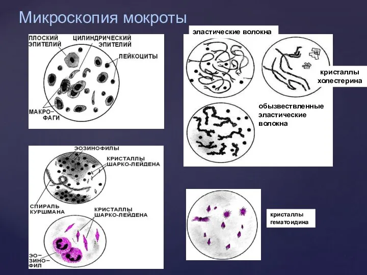 эластические волокна обызвествленные эластические волокна кристаллы гематоидина Микроскопия мокроты кристаллы холестерина