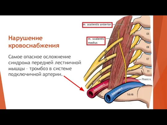 Нарушение кровоснабжения Самое опасное осложнение синдрома передней лестничной мышцы – тромбоз в системе подключичной артерии.