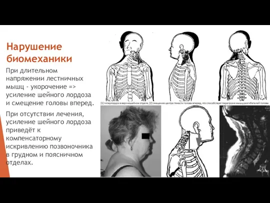 Нарушение биомеханики При длительном напряжении лестничных мышц - укорочение => усиление шейного