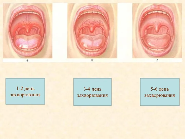 1-2 день захворювання 3-4 день захворювання 5-6 день захворювання