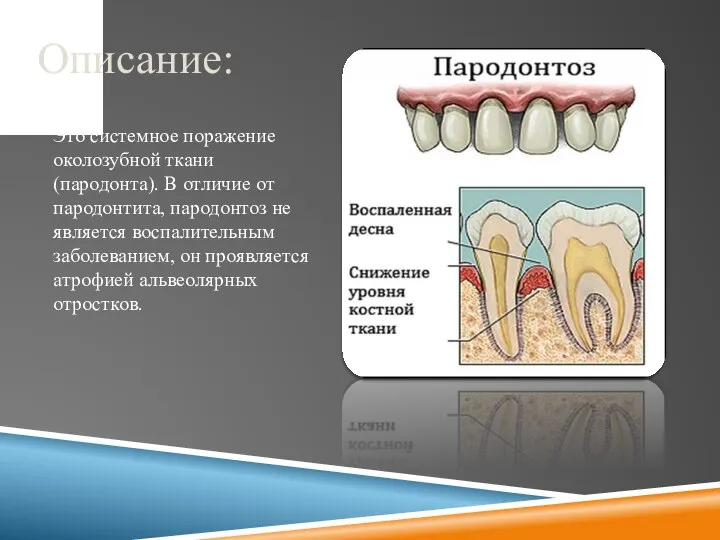 Описание: Это системное поражение околозубной ткани (пародонта). В отличие от пародонтита, пародонтоз