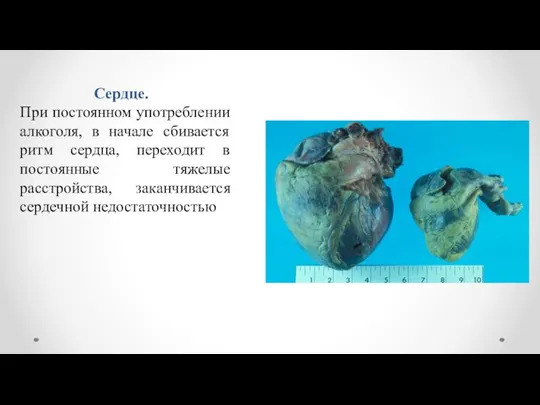 Сердце. При постоянном употреблении алкоголя, в начале сбивается ритм сердца, переходит в