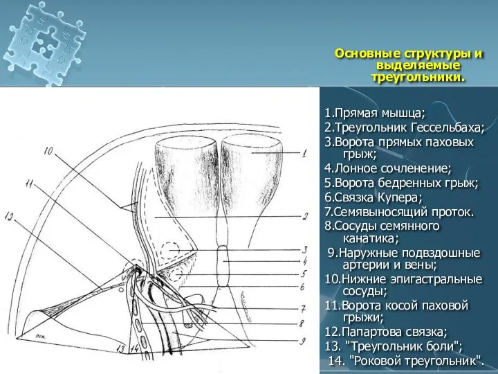 Основные структуры и выделяемые треугольники. 1.Прямая мышца; 2.Треугольник Гессельбаха; 3.Ворота прямых паховых